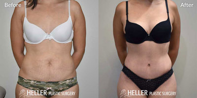 Tummy Tuck before and after photo