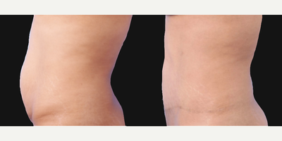 Tummy Tuck before and after photo