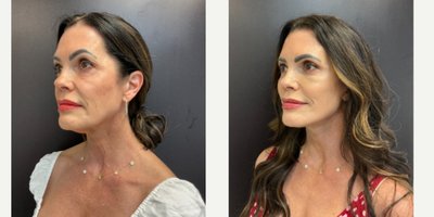 Eyelid Surgery before and after photo