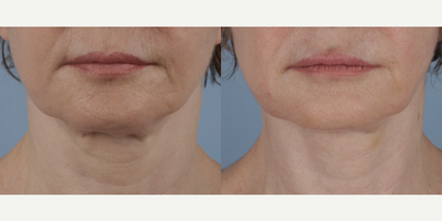 FaceTite before and after photo
