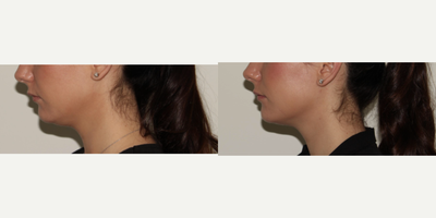 Kybella before and after photo