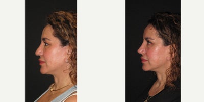 Revision Rhinoplasty before and after photo