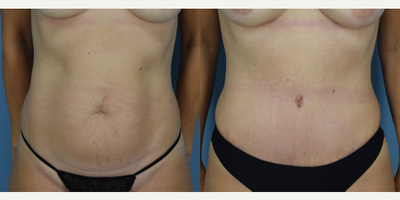 Tummy Tuck before and after photo