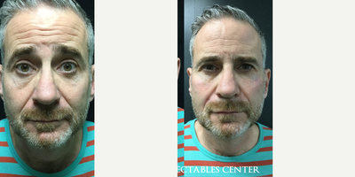 Botox before and after photo