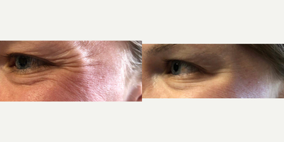 Botox before and after photo