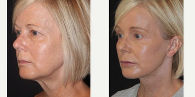 Brow Lift before and after photo