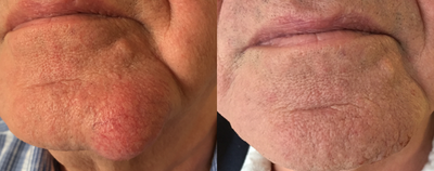 Lipoma Removal before and after photo