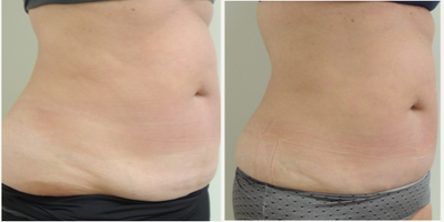 UltraShape before and after photo
