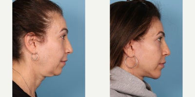 Chin Implant before and after photo