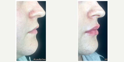 Dermal Fillers before and after photo