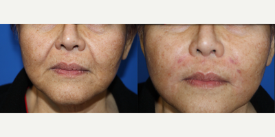 Dermal Fillers before and after photo