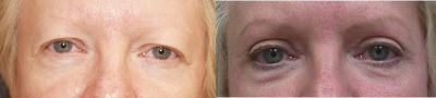 Eyelid Surgery before and after photo