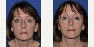 Facelift before and after photo