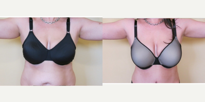 Liposculpture before and after photo
