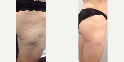 Nonsurgical Butt Lift before and after photo