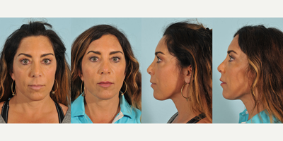 Nonsurgical Nose Job before and after photo