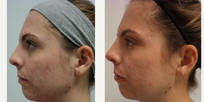 Infini RF before and after photo