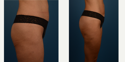 Liposuction before and after photo