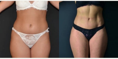 Liposuction before and after photo
