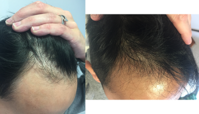 PRP for Hair Loss before and after photo