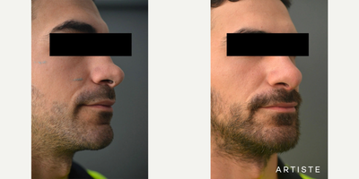 Revision Rhinoplasty before and after photo