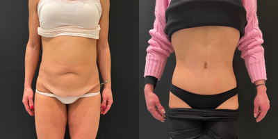 Tummy Tuck before and after photo