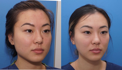 Botox before and after photo