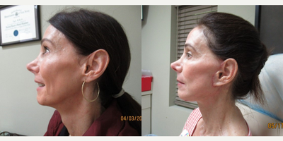 Lower Facelift before and after photo