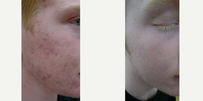 eMatrix before and after photo