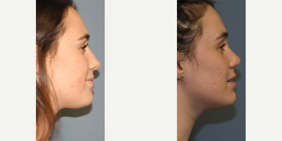 Rhinoplasty before and after photo