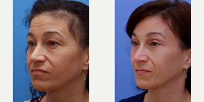 Brow Lift before and after photo