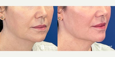Dermal Fillers before and after photo