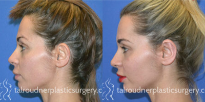 Ear Surgery before and after photo