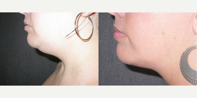 Liposuction before and after photo