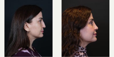 Rhinoplasty before and after photo