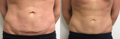 truSculpt before and after photo