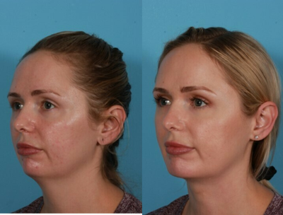 Chin Implant before and after photo