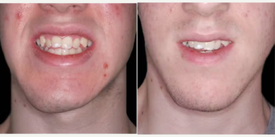 Chin Implant before and after photo