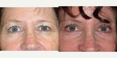 Eyelid Surgery before and after photo