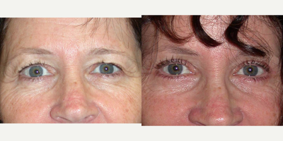 Eyelid Surgery before and after photo