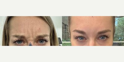 Botox before and after photo