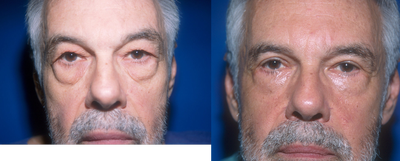Eyelid Surgery before and after photo