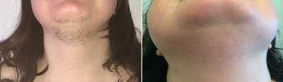 Laser Hair Removal before and after photo