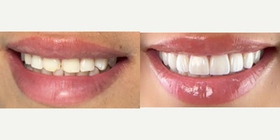 Porcelain Veneers before and after photo