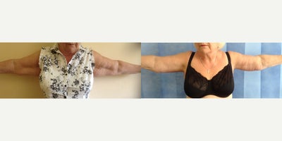 Arm Lift before and after photo