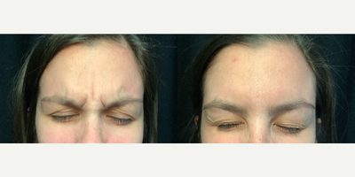 Botox before and after photo