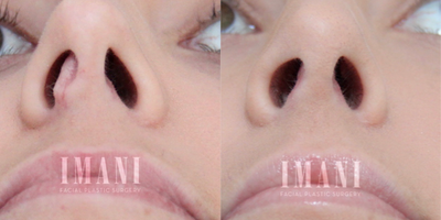 Revision Rhinoplasty before and after photo