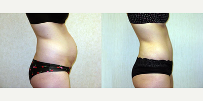 Tummy Tuck before and after photo