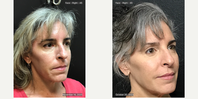 Cheek Fillers before and after photo