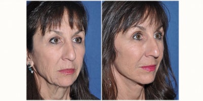 Facelift before and after photo